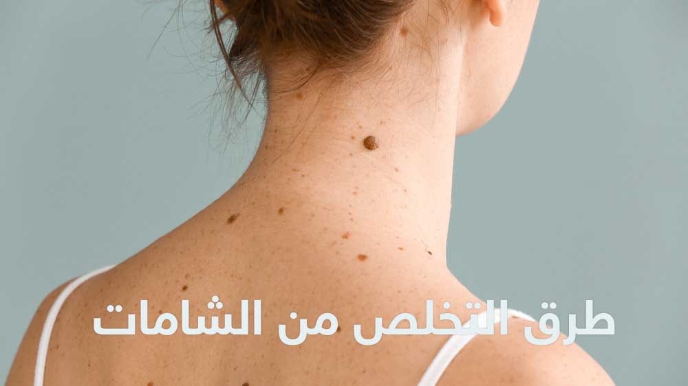 من الشامات