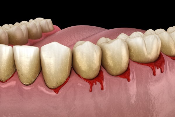 علاج نزيف اللثة بالمنزل 