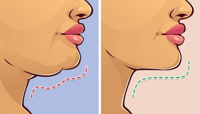 كيف تسحب الدهون من الوجه
