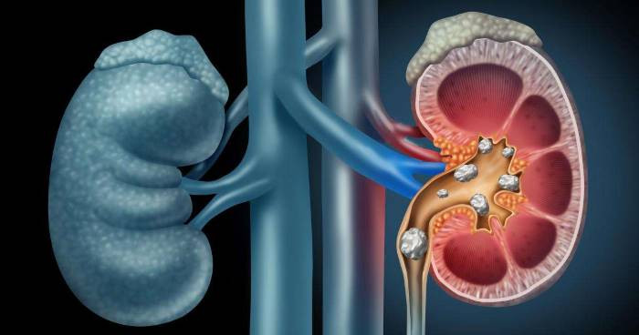 حصى الكلى أسباب علاج أعراض مخاطر الوقاية