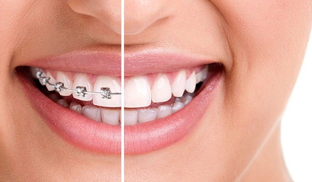 يمكن عمل تقويم الأسنان بعد سن العشرين أونيلا