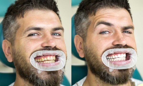 تبييض الأسنان في العيادة