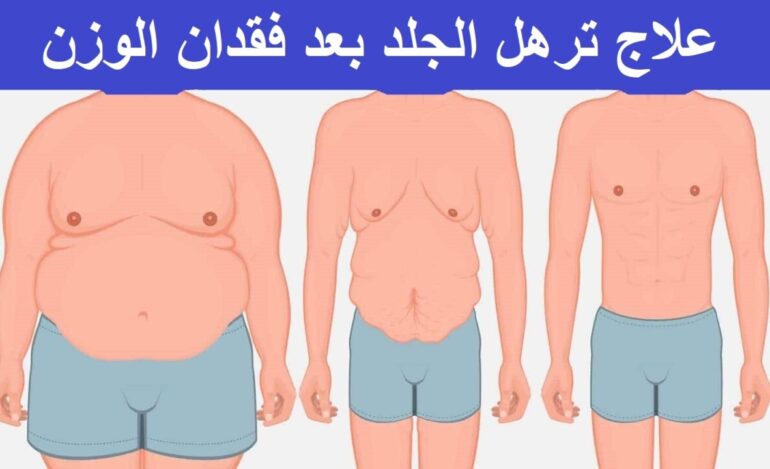 علاج ترهل الجلد بعد فقدان الوزن