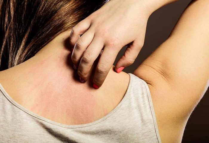 طرق التخلص من الحكة الجلدية