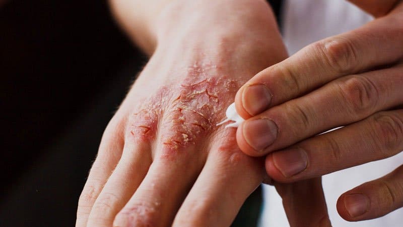 علاجات منزلية لمرض الصدفية