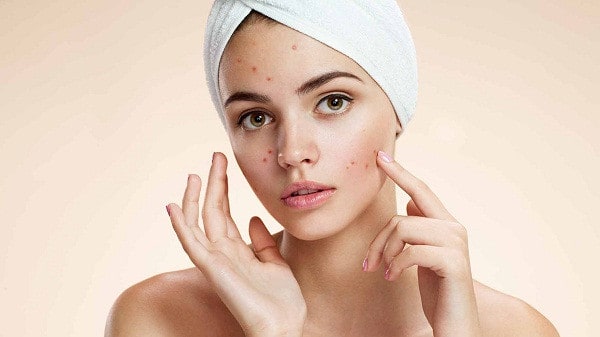 ماسكات مذهلة لعلاج حب الشباب في المنزل