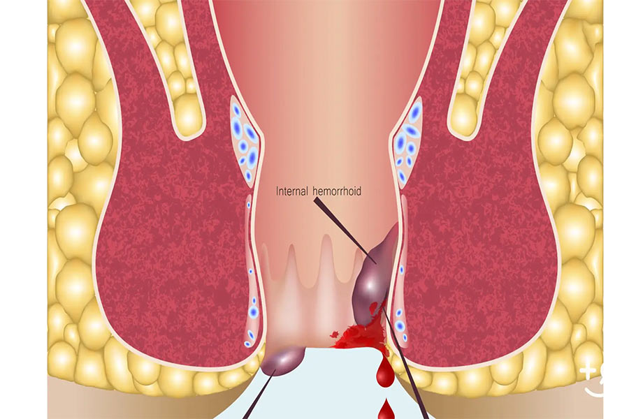 Hemorrhoid bleeding