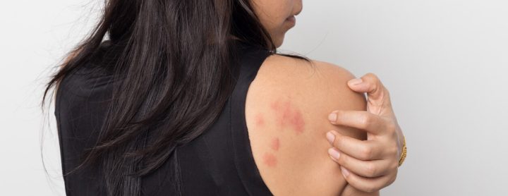 علاج و أسباب تهيج البشرة المفاجئ - أونيلا