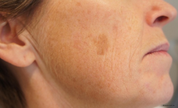 How To Get Rid Of Brown Spots On Face 1 1