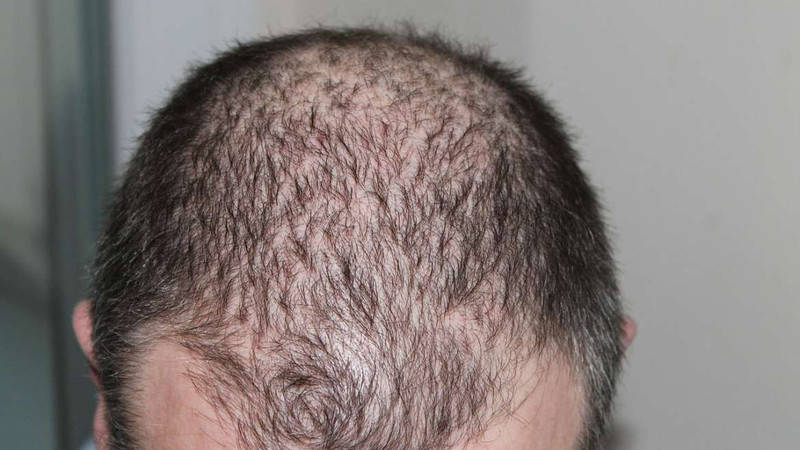 Significant Hair Loss and Thinning 1170x6581 1