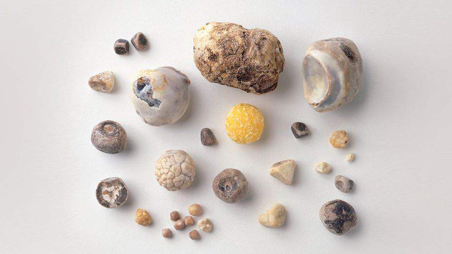 a guide to gallstones rm 1440x8101 1