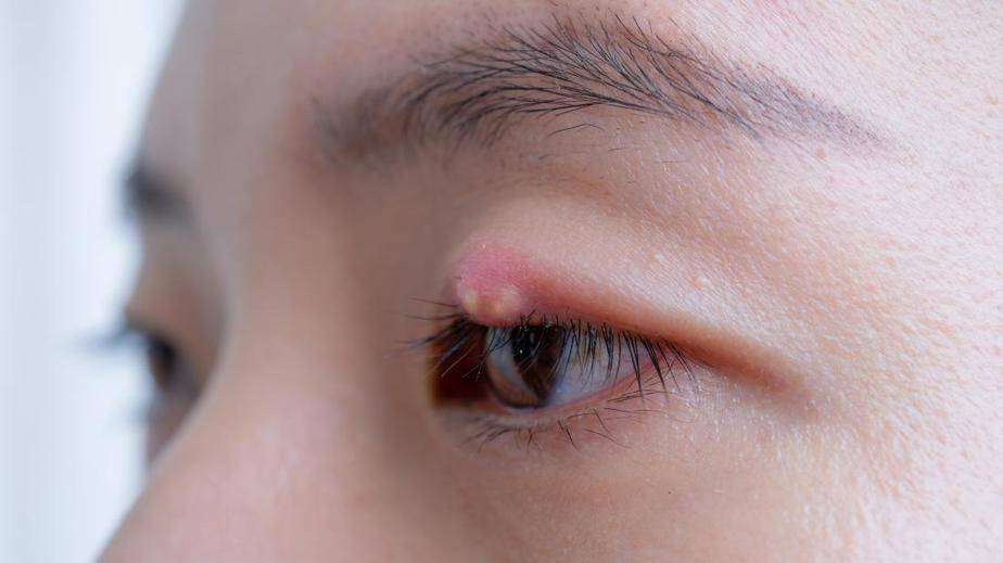 a man with a stye who really needs to know a way of how to get rid of them1