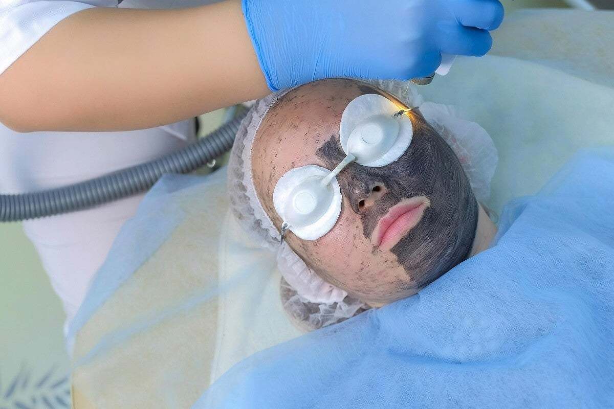 تقشير الوجه