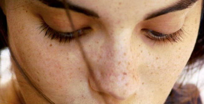 natural remedies age spots 11