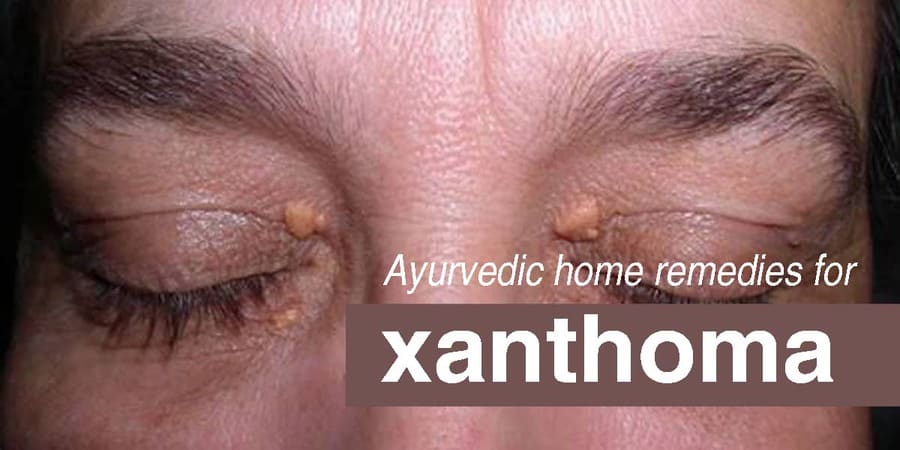 Xanthoma