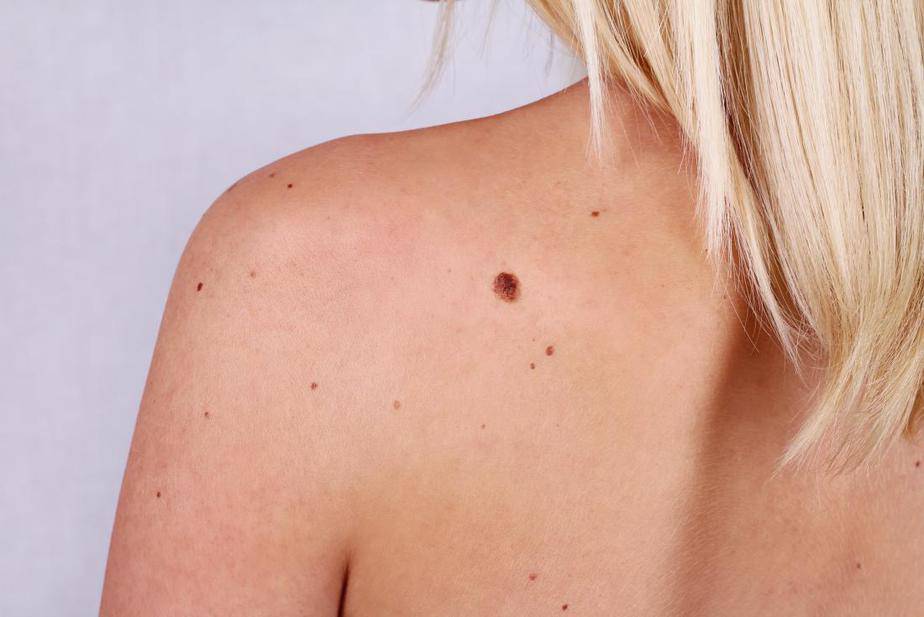 woman wanting to remove a mole on her back